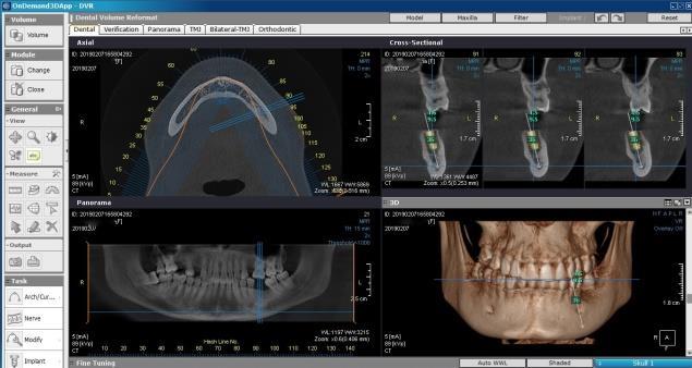 Slika 3. Cone Beam Computed Tomography radiološka dijagnostika Program koji prati CBCT uređaj omogućuje virtualno postavljanje implantata, planiranje i izradu kirurške vodilice za implantaciju.