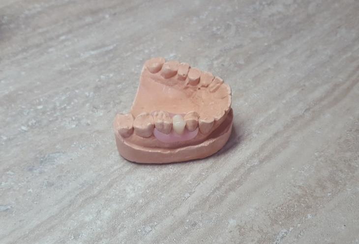 Slika 5. Privremena poliamidna proteza za jedan zub ( žabica ) Oblikovanje proteze ovisi o poziciji i veličini sedla.