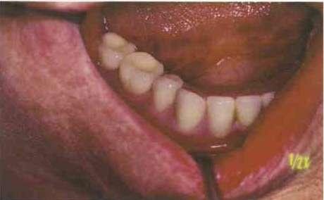 U protruzijskoj kretnji u dodiru trebaju biti incizalni bridovi prednjih zubi i barem po jedan par lateralnih antagonista na lijevoj i desnoj strani.