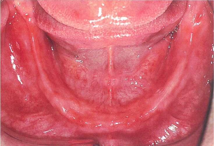 Slika 4. Ležište donje proteze (preuzeto iz 17) Gubitak zuba neizbježno dovodi do resorpcije alveolarne kosti, no opseg resorpcije varira od osobe do osobe.