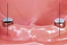 endosealnim implantatima u gornjoj i donjoj čeljusti. Samoporavnavajući mehanizam omogućuje lakši dosjed proteze.