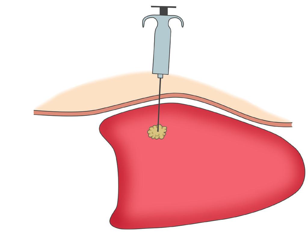 Perkutana biopsija vođena slikom Perkutana biopsija je uzimanje sitnog komadića tkiva s dijela tijela iglom kroz kožu.