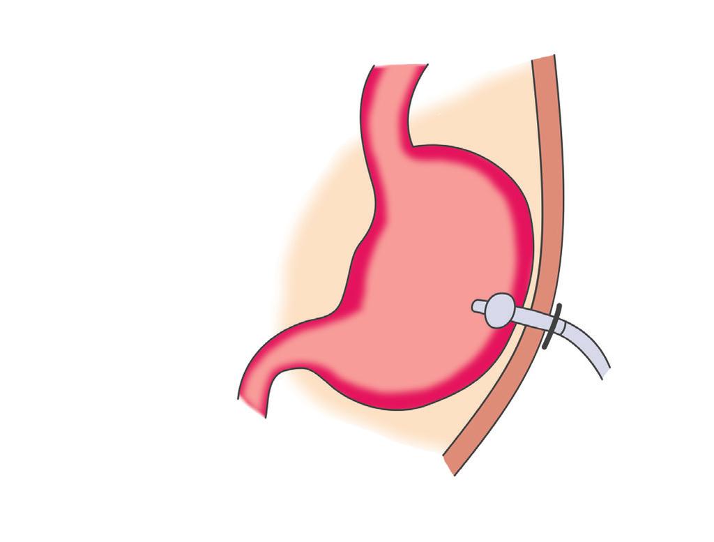 Perkutana gastrostoma Kada pacijent ne može jesti i piti, može biti hranjen preko cijevi (koja se zove gastrostoma) koja je direktno postavljena u želudac preko abdominalne stijenke.