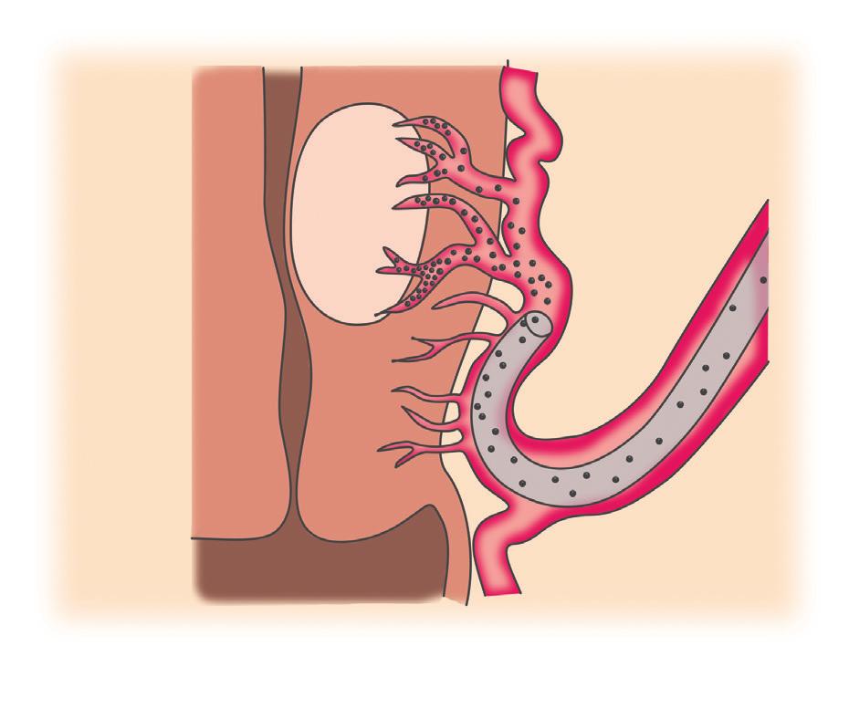 Embolizacija uterinih arterija Embolizacija maternice je postupak u kojem intervencijski radiolozi mogu proći s tankom cijevi (kateter) u krvne žile koje opskrbljuju maternicu (maternične arterije) i