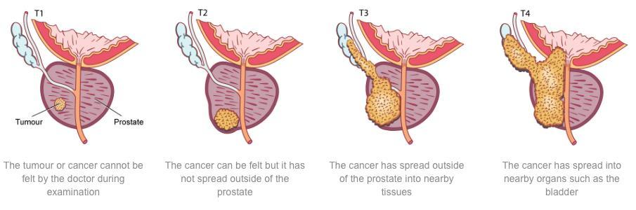 Slika 1. Prikaz tipične lokalizacije i procesa širenja raka prostate (preuzeto s https://sunshinecoasturology.com.