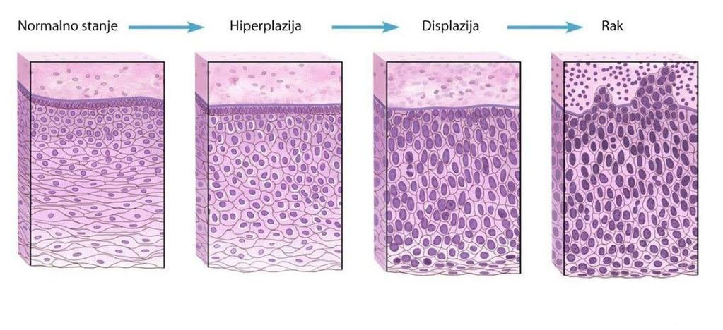 Slika 2: Proces nastajanja tumora Izvor:http://www.onkologija.hr/sto-je-rak/ Veliĉna ovih bolesti je nazvana prema organu ili tipu stanice u kojoj je nastala, odnosno prema njezinom primarnom sijelu.
