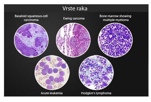 Slika 3: Vrste raka Izvor:http://www.onkologija.hr/sto-je-rak/ Metastatske stanice izgledom i ponašanjem odgovaraju stanicama primarnog sijela raka.