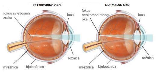 6.2. Kratkovidnost Kratkovidnost predstavlja poremećaj lomljenja zraka u oku u kojem kada je akomodacija opuštena, paralelno usmjereno svjetlo proizvodi sliku ispred mrežnice umjesto na mrežnici kako
