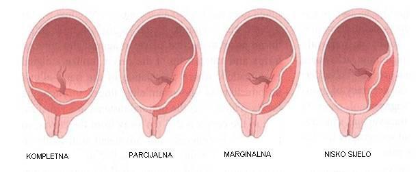 Slika 3. U gotovo 50% slučajeva, nađe se nisko sijelo posteljice ili marginalna placenta previja.