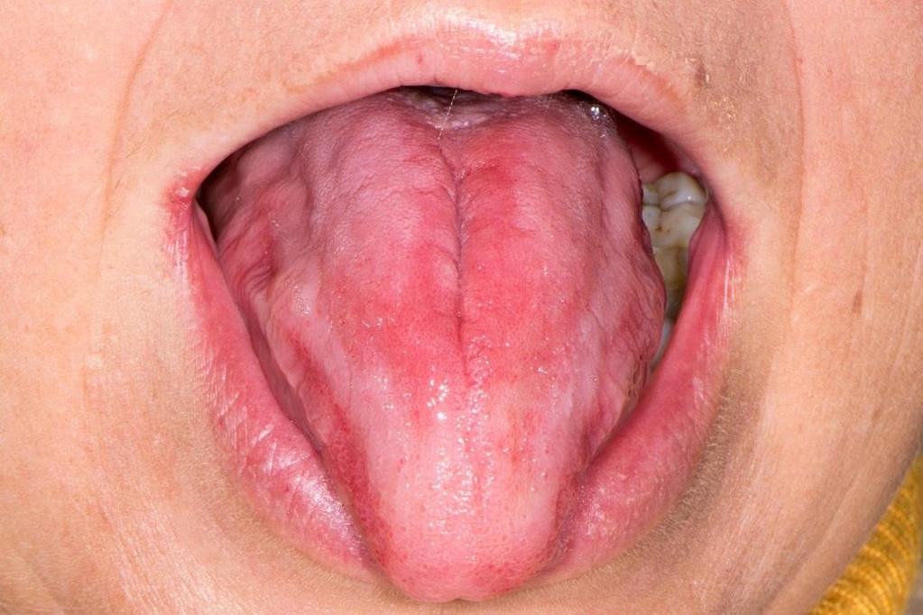 kemoterapeutici može biti atrofija jezika. U slučaju infekcije šarlahom, nakon obloženosti jezika javlja se gladak, tamnocrveni jezik s naglašenim papilama koji nazivamo malinastim jezikom.