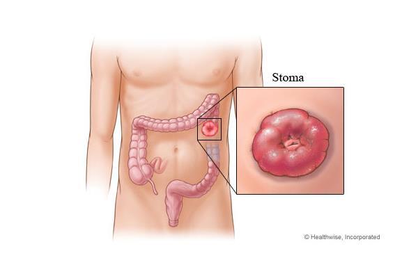 stolice i vjetrova. U tu se svrhu radi tzv. zaobilazna crijevna anastomoza ili kolostoma, ovisno o lokalizaciji tumora (slika 3).