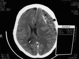 3.3.1 Kronični subduralni hematom Ta bolest je u bolesnika starije dobi među najučestalijim neurokiruškim bolestima.