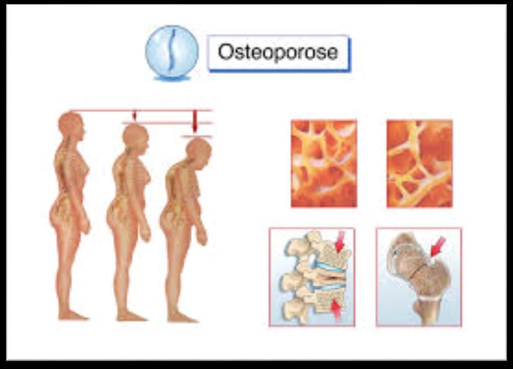 Slika 5.1.1 Osteoporoza Izvor: tp://www.ratiopharm.at/files/pdf1/2119_osteoporose_hr.pdf 5.2. Ponašajni rizični faktori Ponašajni faktori tiču se ljudskog ponašanja, emocija ili svakodnevnih izbor i podložni su promjenama.