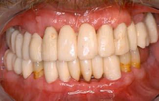 a Krajnji ishod protetske terapije Figure 3A Definitive dental prostheses, frontal view. Slika 3.