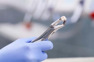 Vađenje zuba Svaki pokvareni zub koji se više ne može koristiti mora biti izvađen. Indikacije Zub se može izvaditi pomoću poluga i kliješta.
