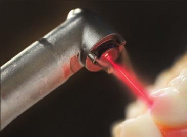 LASER u stomatologiji Laser omogućava izvođenje brzih i manje bolnih stomatoloških usluga i tretmana uz manju potrebu pribjegavanja klasičnom «svrdlu».