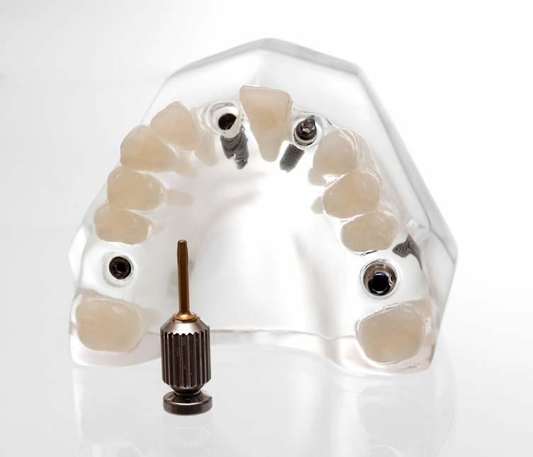 Tehnika All on Four Ova tehnika omogućava da se dobiju «novi» zubi uz samo četiri implantata na koja se pričvršćuje totalna proteza. Ovo je rješenje optimalno za osobe koje su izgubile veći broj zuba.