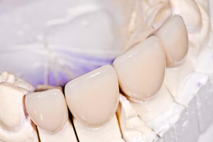 Keramičke ljuskice Keramičke ljuskice su nadomjesci koji mijenjaju boju, oblik i poziciju zuba.