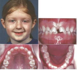 3.1.1. Karakteristike mliječne denticije Mliječna denticija broji 20 zuba, po 10 u svakoj čeljusti, odnosno 5 u svakom kvadrantu (2 sjekutića, 1 očnjak i 2 kutnjaka).
