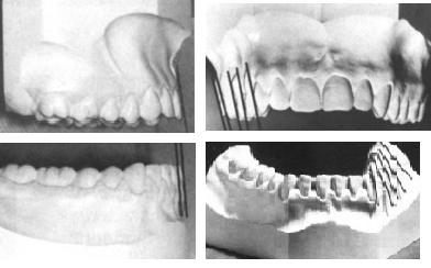 Slika 5. Inklinacija kruna zubi u gornjoj i donjoj čeljusti.