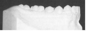 Odsutstvo dijastema unutar zubnog niza 6.