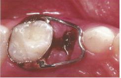 Prsten moţe biti konfekcijski ili laboratorijski i moţe se smjestiti i na trajni i na mliječni molar.