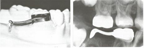 Ukoliko nedostaje samo 2. mliječni molar, ploha vodilja je fiksirana za prsten koji je cementiran na zub.