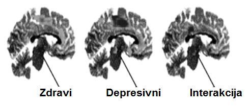 Slika 10 Povećanje metabolizma od budnosti do REM spavanja u pojedinom moždanim strukturama kod depresivnih pacijenata u odnosu na zdrave kontrole Modifikovano na osnovu Nofzinger i sar.