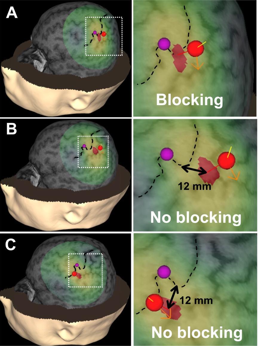Blokiranje osjeta stimulacijom primarne somatosenzoričke kore (S1) Ovisno o kutu rotacije zavojnice