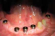 U zubnim naslagama žive mnogobrojne i različite bakterije.