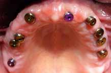 Infekcija, kao što je parodontopatija predstavlja veliki rizik za gubitak implanta!