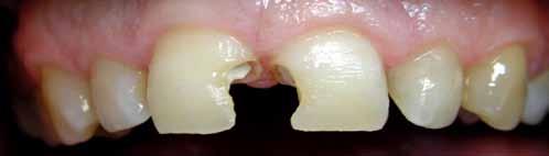Nekoliko (minimum dva) implanata znatno poboljšava fiksiranje proteza. Šta ako sam bez zuba?