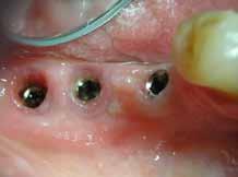 zubi. Dakle, primaran interes stomatologa i pacijenta je zdravlje prirodnih zuba.