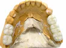bruse. Takođe, most na implantima može da zameni nekoliko izgubljenih zuba.