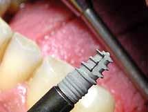 Stručnjaci se slažu: Ništa se u stomatologiji nije pokazalo korisnijim od zubnih