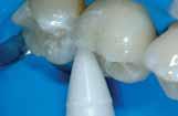 OneGloss Kit 20 Midi vrhova / 20 Kupičastih / 20 Disk IC / 3 mandrele CA 430 kn+pdv 378,40 kn+pdv susjednih rekonstrukcija Završne obrade i poliranje zubi nakon uklanjanja ortodontskih pomagala