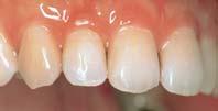 Kou Hinoura, zub 36, boja 3 Prof. Chiara aroni, sluèaj Molar Incisor Hypoplasia, zub 46 Lako se upotrebljava i reproducira željena boja zbog kameleonskog efekta.