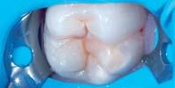 Dubina demineralizacije dentina kod jetkanja ovisi o više èimbenika: Vremenu aplikacije, koncentraciji kiseline, ph, surfaktanata i gustoæe materijala.