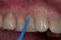 dentinskih tubula. Polarna molekula UniSeala LC veže se za površinske molekule dentina, zatvarajuæi savršeno dentinske tubule.
