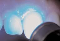 NPOMEN: Prije tretmana sa UniSeal LC: - Istrljati površinu zuba sa EDT tekuæinom 20 sekundi - spirirati i ostaviti malo vlažno 22 043510 Desensibilizator