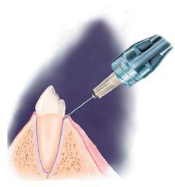 Ova revolucionarna tehnika omoguæuje stomatologu da zamijeni mandibularnu blok anesteziju sa efikasnijom i jednostavnijom intraligamentarnom (PDL) anestezijom, kao
