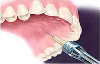 Tehnologija ST, aprat je proglašen revolucionarnim i ubraja se u nekoliko znaèajnih inovacija u stomatologiji XX.