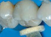 Otklanjanje cementa za abraziju bez ošteæenja susjednih rekonstrukcija Završne obrade i poliranje zubi nakon uklanjanja ortodontskih pomagala Odstranjivanje
