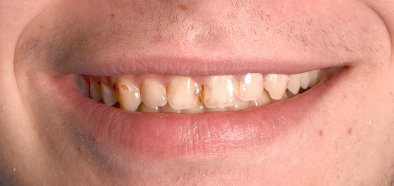 3.2.3. Abfrakcija Abfrakcija nastaje zbog savijanja zuba uzrokovanog okluzalnim opterećenjem i parafunkcijama, a klinički se očituje kao klinasta lezija u području zubnog vrata.