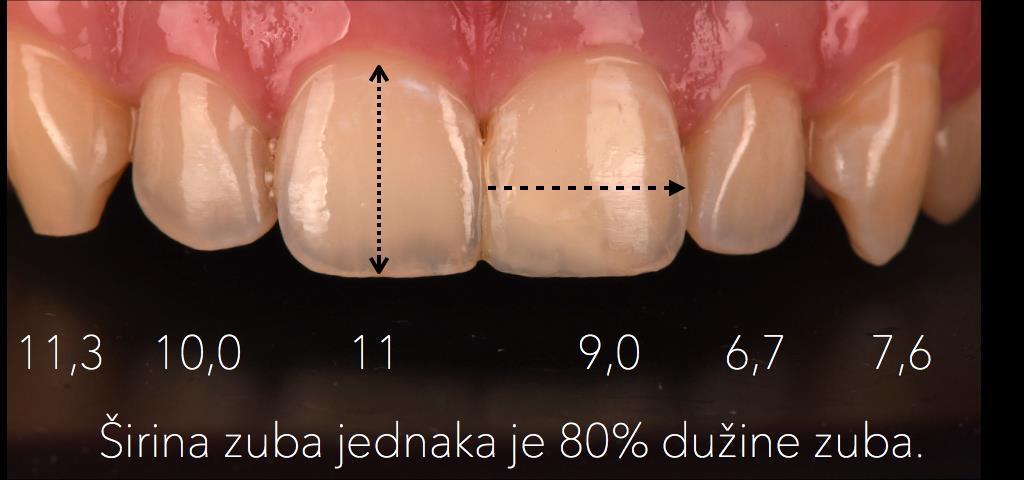 U slučaju rekonstrukcije samo jednog dijela zuba ili nekoliko zubi u čeljusti, oblik je moguće reporoducirati vodeći se oblikom preostalih zubi.