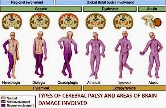 Slika 11. predstavlja plastičan prikaz regija oštećenja mozga obzirom na različite tipove cerebralne paralize, kao i razlike u ozbiljnosti zahvaćenosti tijela. Slika 11.