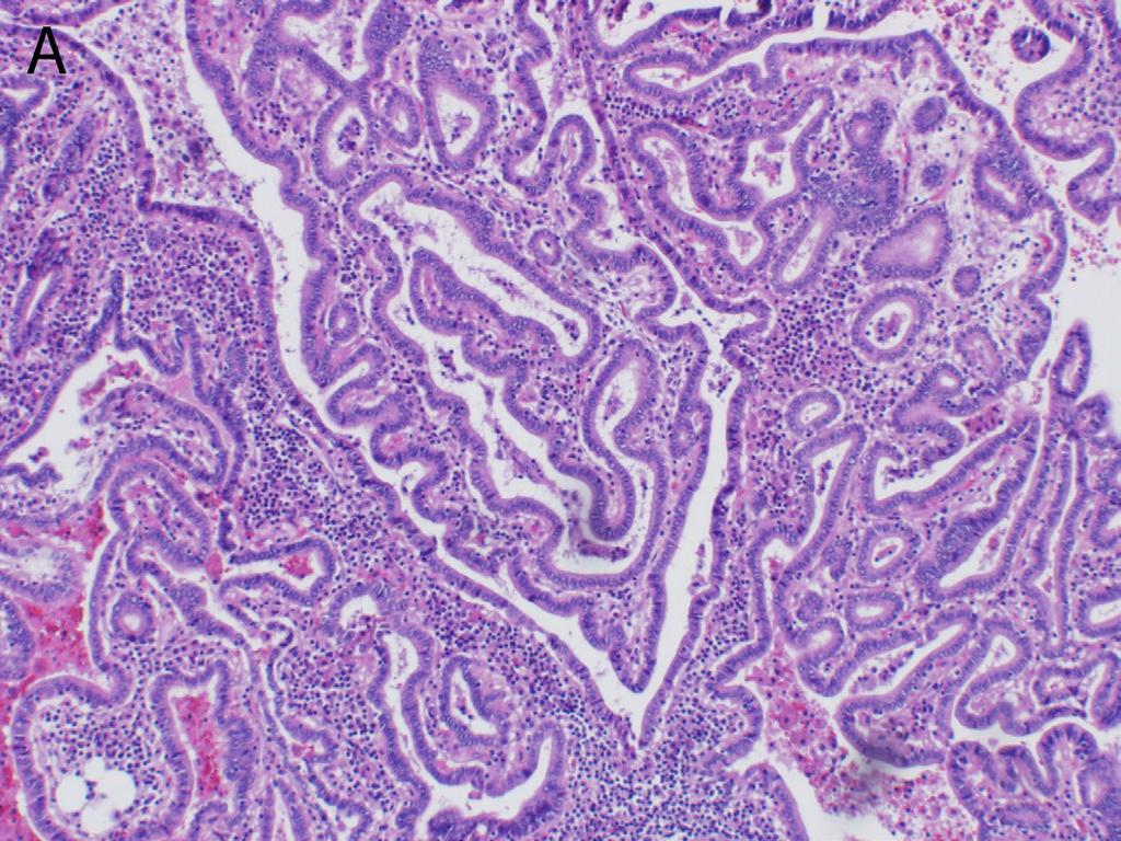 U stromi su često prisutni depoziti kalcijuma u vidu sferičnih, lamelarnih, bazofilnih psamoznih telašaca, kao i inflamatorni infiltrat limfocita različite gustine (slika 2) (5).