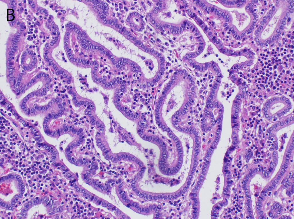 tako se uz papilarni karcinom najčešće nalaze pridružene bolesti štitaste žlezde u vidu strume ili Hašimoto tireoiditisa (6). Slika 1.