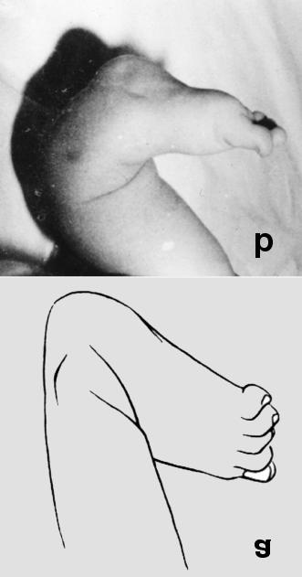 Slika 1. Shematski prikaz kalkaneo-valgusnog stopala. Peta (kalkaneus) je izbočena i u valgus položaju. Prednji dio stopala je u dorzifleksiji (a).