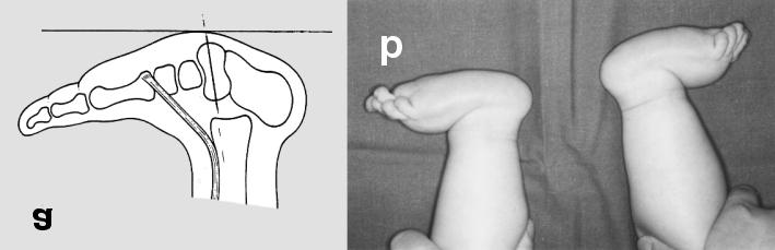 Talus vertikalis Slika 3. Shematski prikaz položaja kostiju stopala s talus vertikalis deformacijom. Prikazan je gotovo okomiti položaj talusa i skraćena tetiva prednjeg tibijalnog mišića (a).